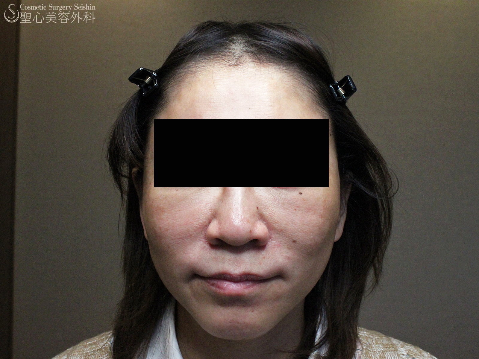 【40代女性】ウルセラ（ダウンタイムゼロのリフトアップ） Before 