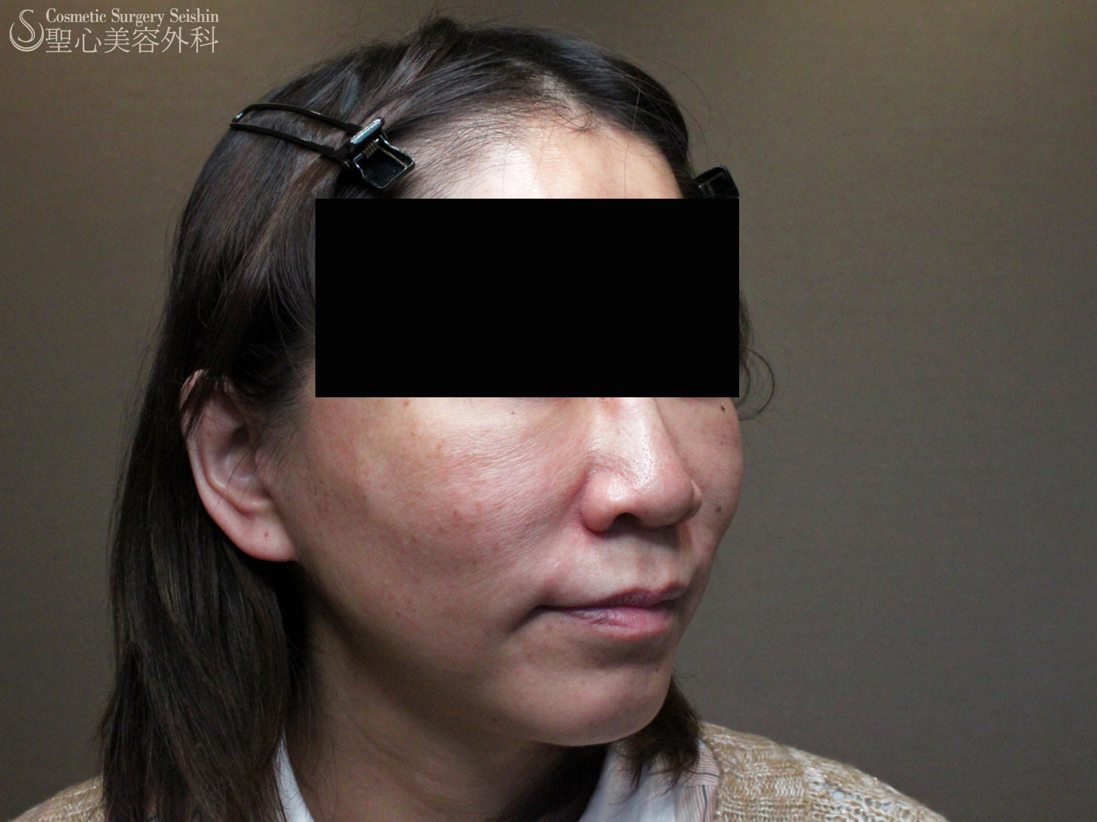 【40代女性】ウルセラ（ダウンタイムゼロのリフトアップ） Before 