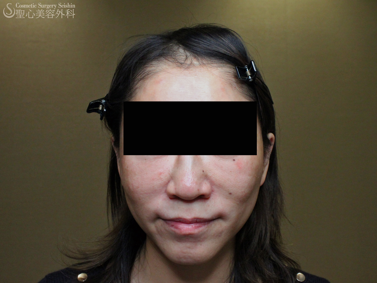 【40代女性】ウルセラ（ダウンタイムゼロのリフトアップ） After 
