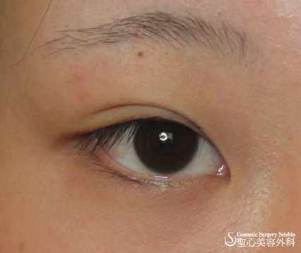 【20代女性：平行型二重】埋没法＋目頭切開 Before 