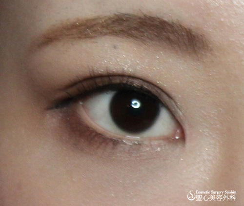 【20代女性：平行型二重】埋没法＋目頭切開 After 