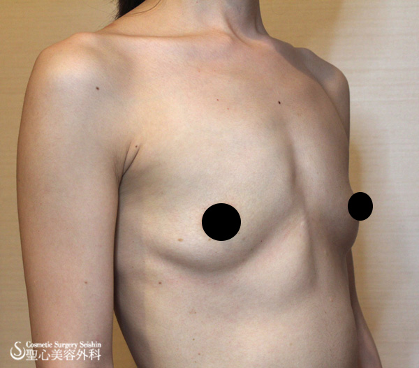 【30代・女性】豊胸術（メモリージェルバッグ、２２５ｃｃ） Before 