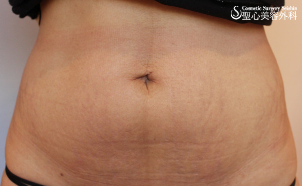 【20代女性・妊娠線/腹部のたるみ】イントラセル After 