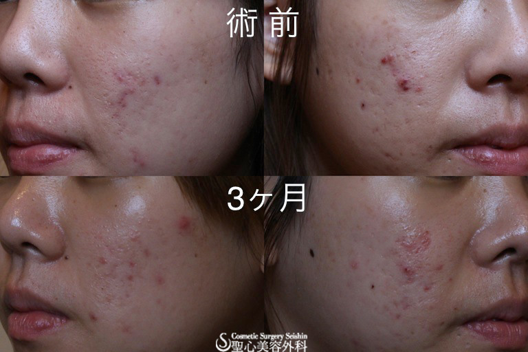 【20代女性 ニキビ跡】イントラセル After 