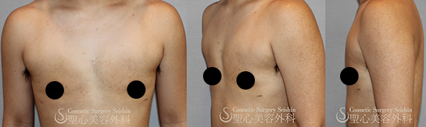 【20代女性・男性のような平らな胸に近づける】FTM 乳腺切除（1ヶ月後） After 