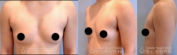 【20代女性・男性のような平らな胸に近づける】FTM 乳腺切除（1ヶ月後） Before 