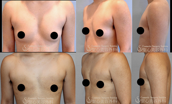 【20代女性・男性のような平らな胸に近づける】FTM 乳腺切除（1ヶ月後） After 