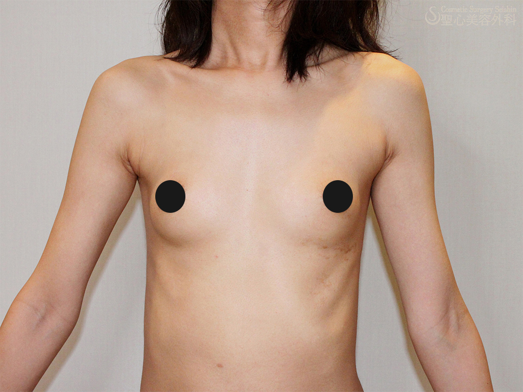 【30代女性・体重38kg】セリューション豊胸術＋ピュアグラフト Before 