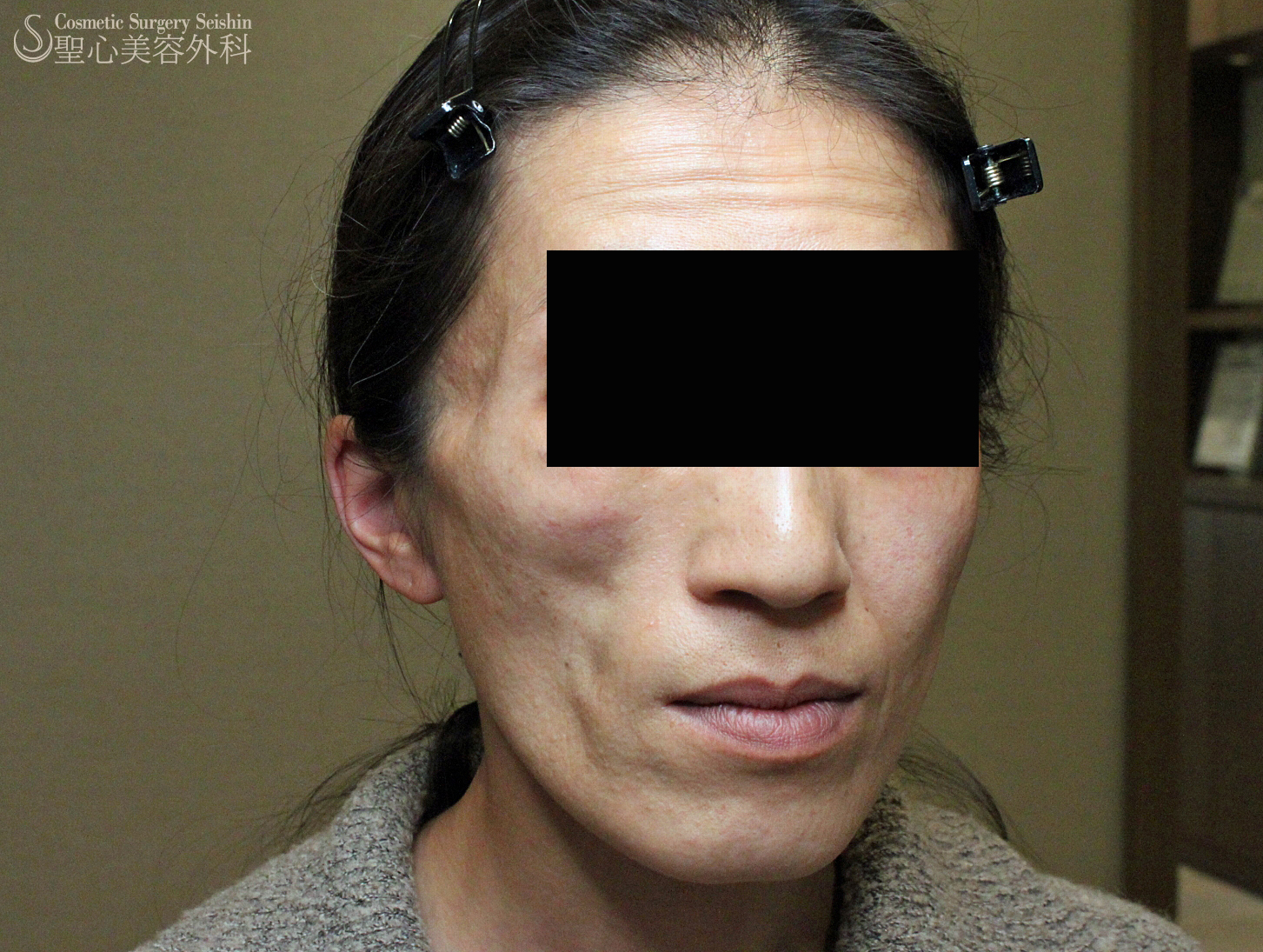 【40代女性・顔面片側萎縮症（ロンバーグ病）】プレミアムPRP Before 