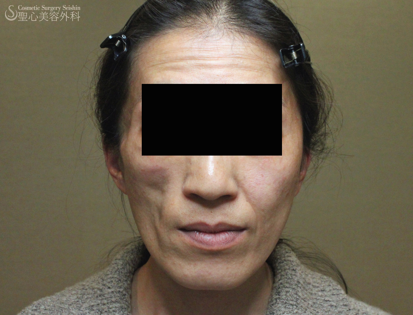 【40代女性・顔面片側萎縮症（ロンバーグ病）】プレミアムPRP Before 