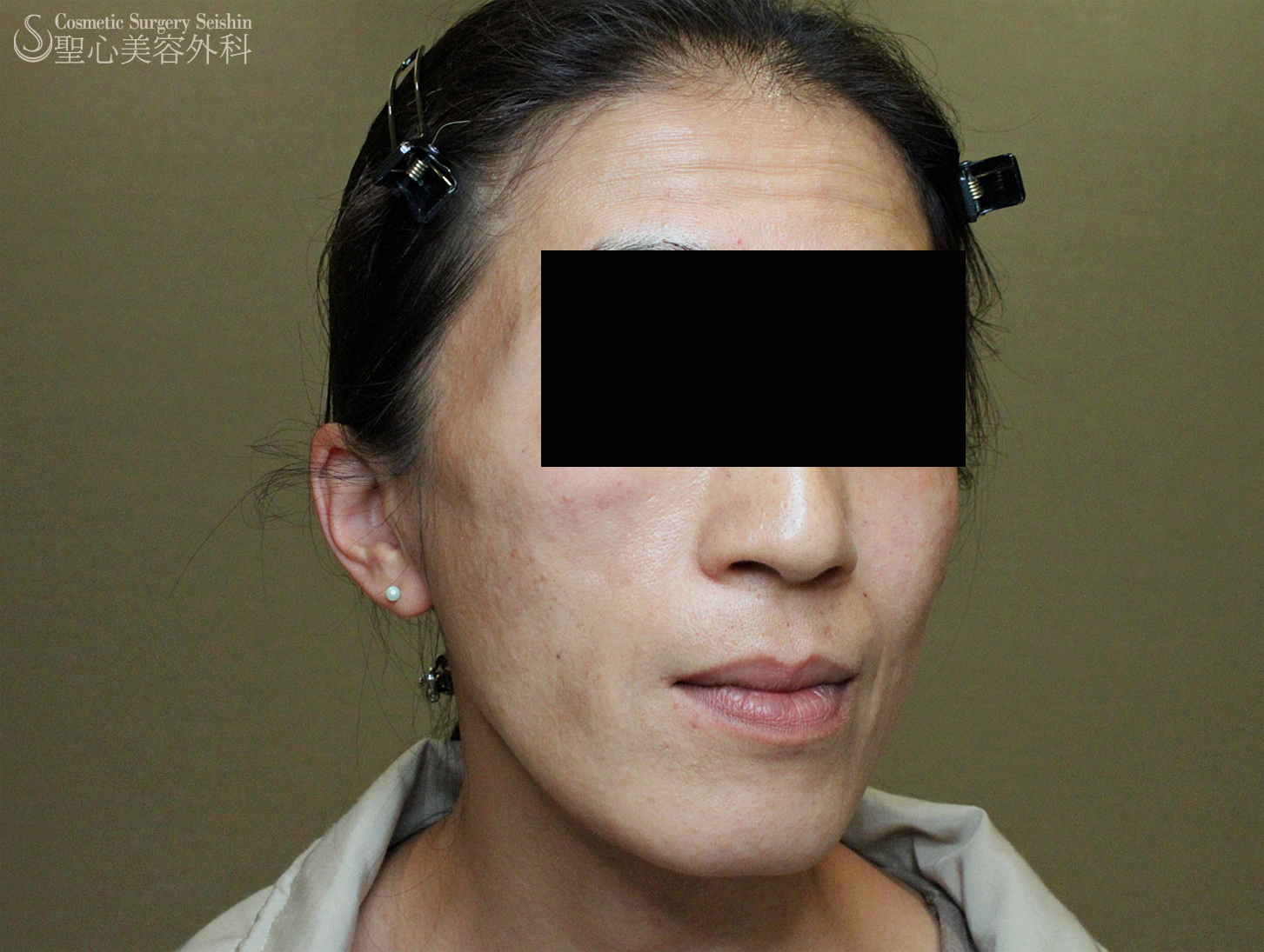 【40代女性・顔面片側萎縮症（ロンバーグ病）】プレミアムPRP After 
