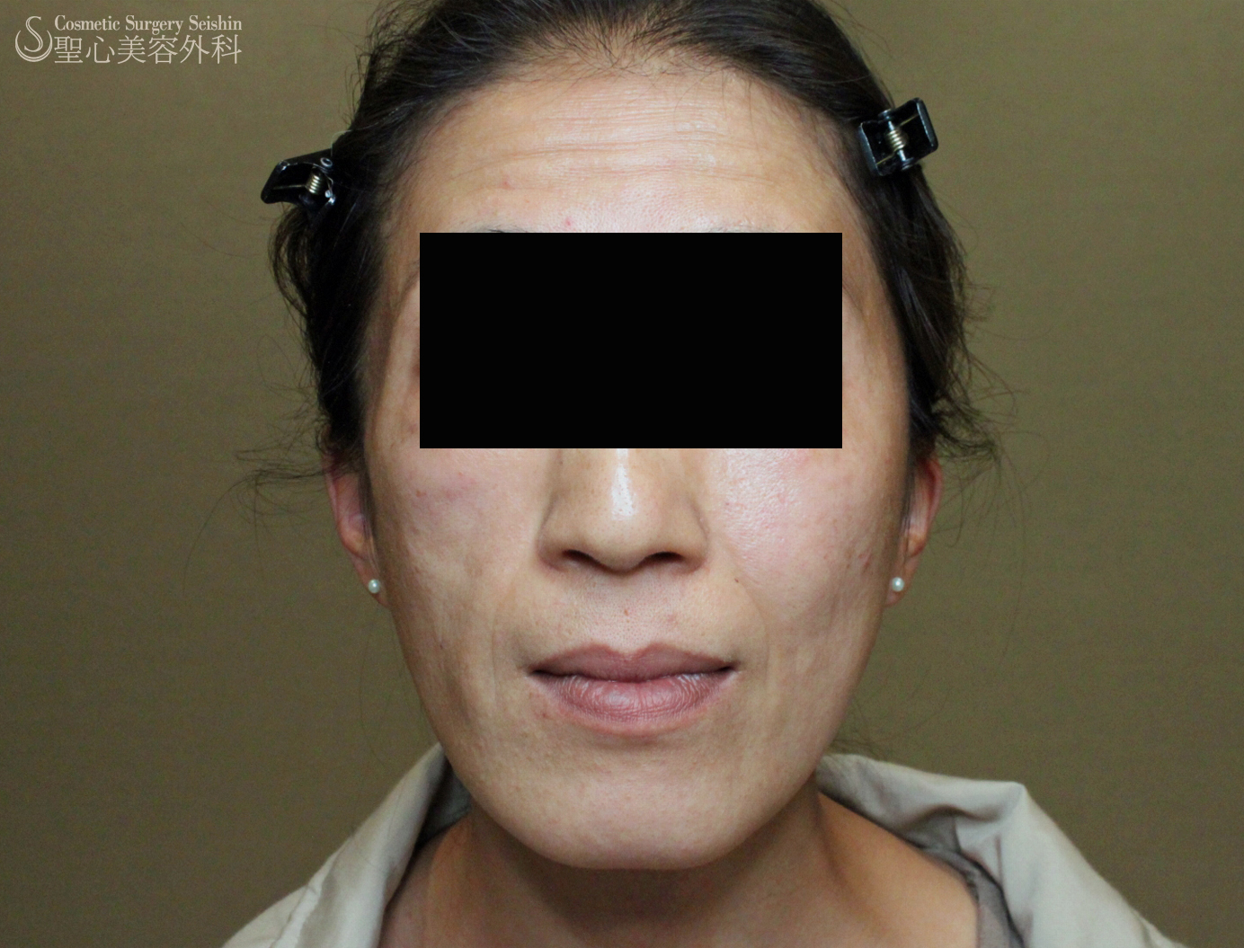 【40代女性・顔面片側萎縮症（ロンバーグ病）】プレミアムPRP After 