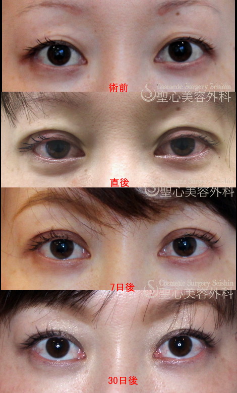 【30代女性・奥二重⇒二重】二重埋没法（1ヶ月後） After 