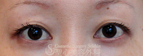 30代女性 奥二重 二重 二重埋没法 1ヶ月後 症例写真 美容整形 美容外科なら聖心美容クリニック 30代女性 奥二重 二重 二重埋没法 1ヶ月後 症例写真 美容整形 美容外科なら聖心美容クリニック