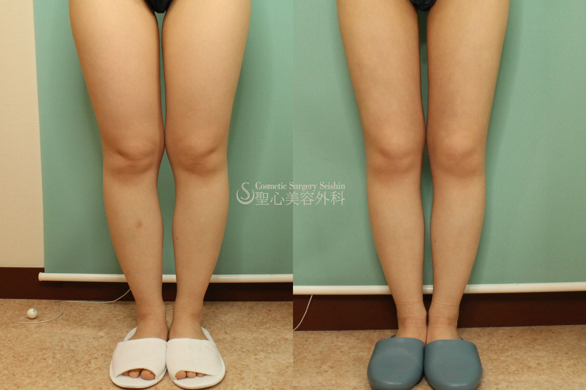 【20代女性・下半身ボディジェット脂肪吸引】 After 