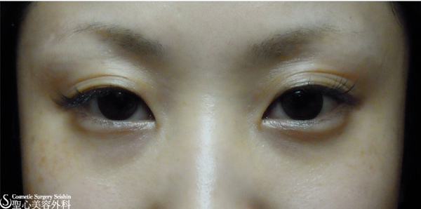 【２０代・女性】二重埋没法の経過 Before 