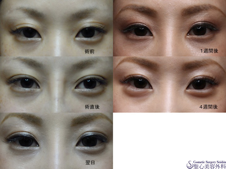 【２０代・女性】二重埋没法の経過 After 