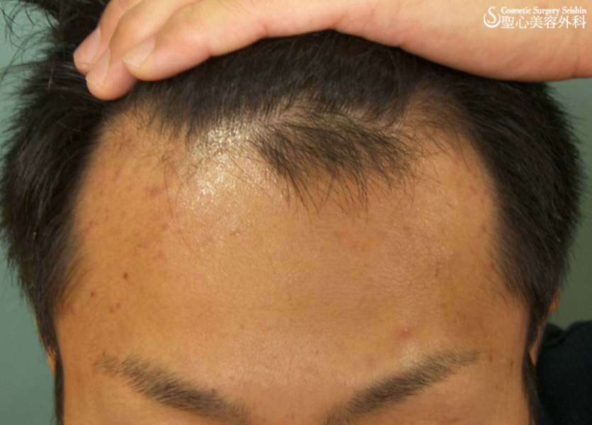 30歳男性 生え際の薄毛の改善 プロペシア aga治療薬 外用薬併用 症例写真 美容整形 美容外科なら聖心美容クリニック