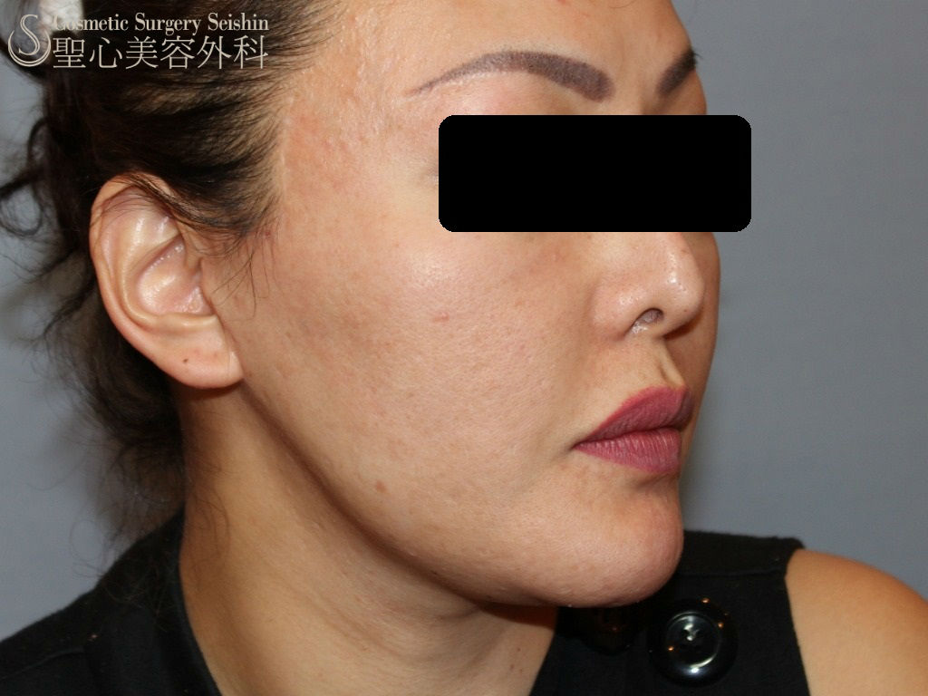 【30代・女性】ドクターハイフ（ウルセラシステム）（頬、フェイスラインのリフトアップ、小顔効果） After 