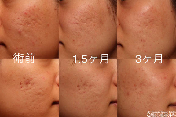 【20代女性・ニキビ跡】イントラセル After 