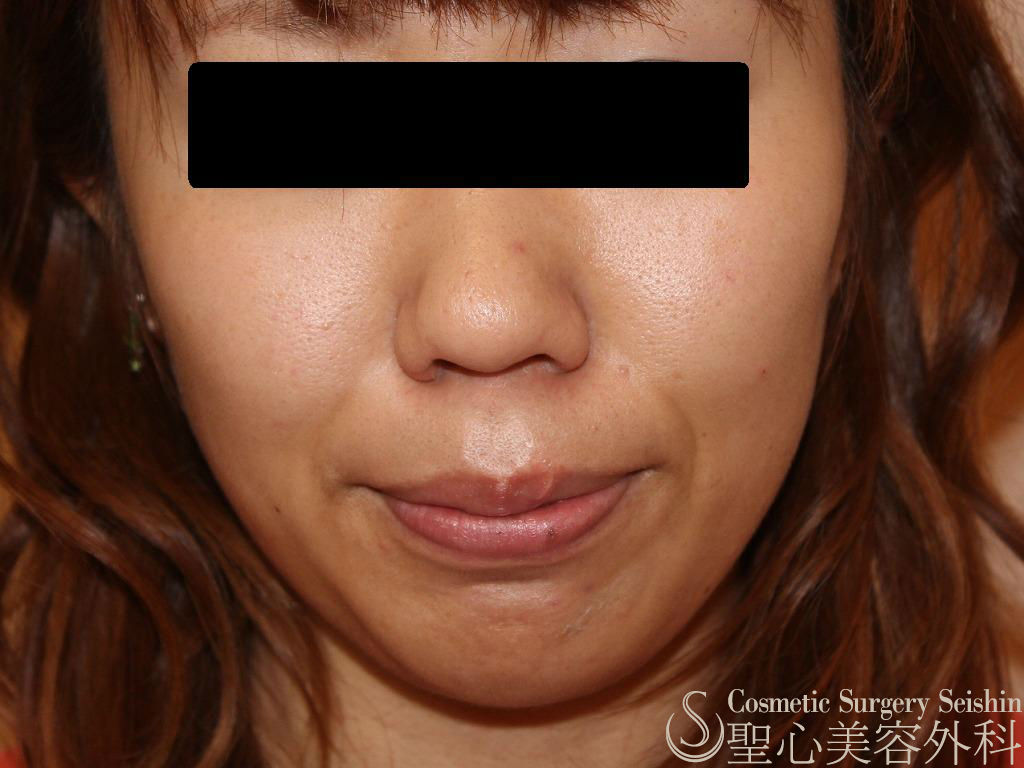 代女性 たるみ ほうれい線 プレミアムprp皮膚再生療法 症例写真 美容整形 美容外科なら聖心美容クリニック 代女性 たるみ ほうれい線 プレミアムprp皮膚再生療法 症例写真 美容整形 美容外科なら聖心美容クリニック