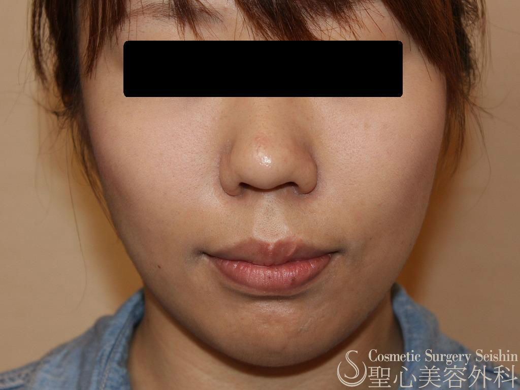 代女性 たるみ ほうれい線 プレミアムprp皮膚再生療法 症例写真 美容整形 美容外科なら聖心美容クリニック 代女性 たるみ ほうれい線 プレミアムprp皮膚再生療法 症例写真 美容整形 美容外科なら聖心美容クリニック