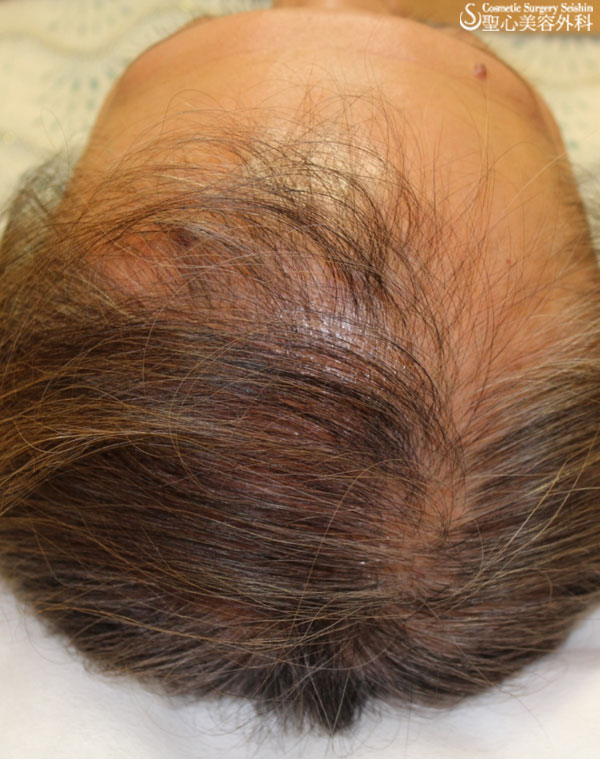 【60代女性：薄毛】グロースファクター再生療法・女性用飲む育毛剤・KIPスカルプヘアエッセンス Before 
