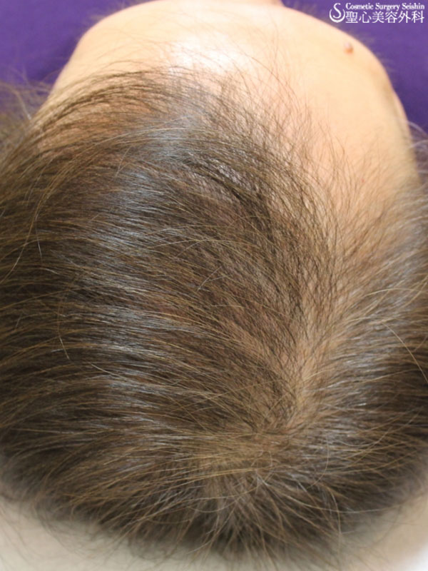 【60代女性：薄毛】グロースファクター再生療法・女性用飲む育毛剤・KIPスカルプヘアエッセンス After 