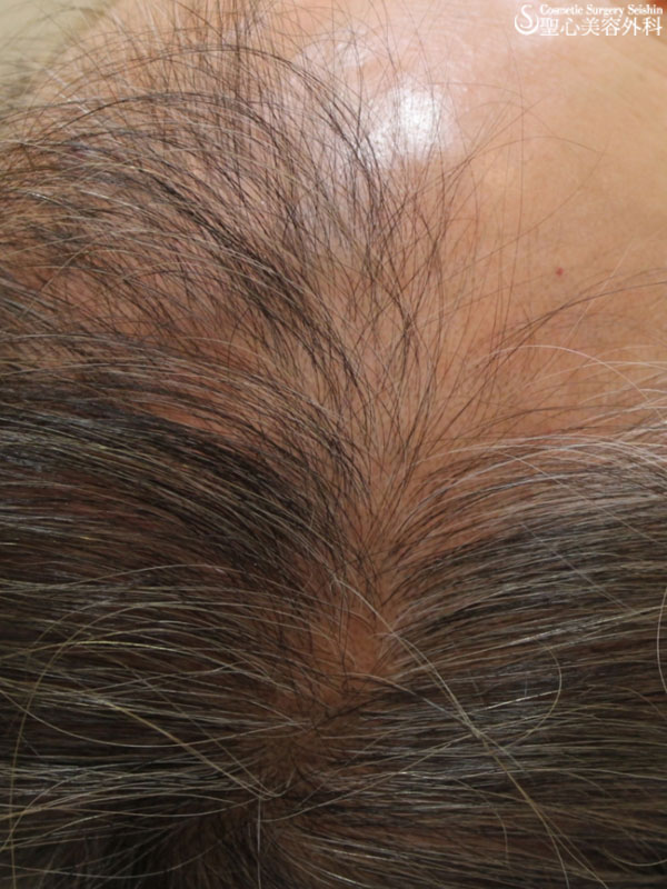 【60代女性：薄毛】グロースファクター再生療法・女性用飲む育毛剤・KIPスカルプヘアエッセンス Before 