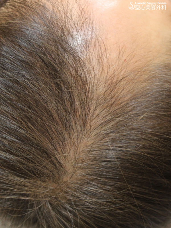 【60代女性：薄毛】グロースファクター再生療法・女性用飲む育毛剤・KIPスカルプヘアエッセンス After 