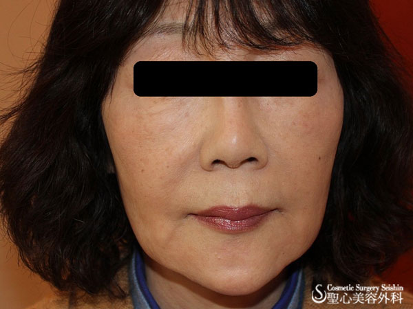 【60代女性：切らない若返り】アキュパンクチュアリフト After 