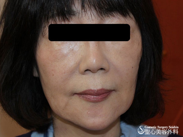 【60代女性：切らない若返り】アキュパンクチュアリフト Before 