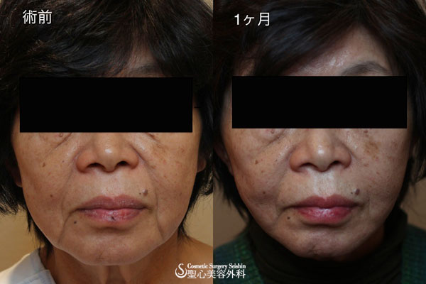 【60代女性・頬のたるみ】プレミアムミニリフト After 