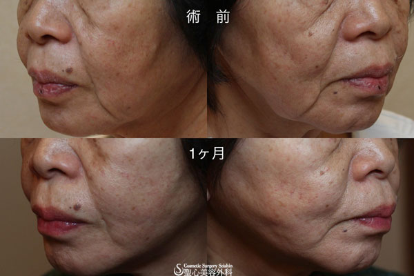 【60代女性・頬のたるみ】プレミアムミニリフト After 