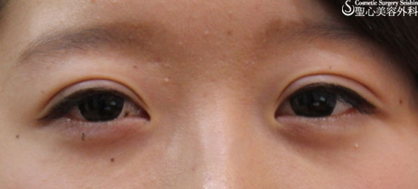 【女性】他院埋没法の修正（三重⇒二重） After 