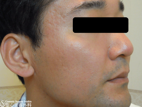 30代男性 イントラセル 頬 こめかみのニキビ跡治療 症例写真 美容整形 美容外科なら聖心美容クリニック