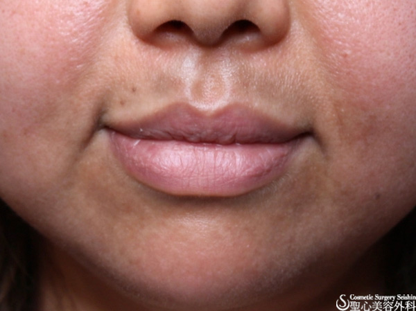 ４０代 女性 口周りの黒ずみ 肝斑 症例写真 美容整形 美容外科なら聖心美容クリニック