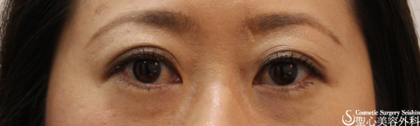 【女性】眼瞼下垂（埋没法）３年後 After 