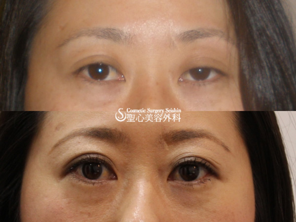 【女性】眼瞼下垂（埋没法）３年後 After 