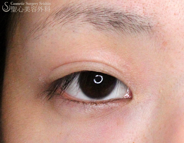【20代女性・二重埋没法】術後経過（8日目） Before 