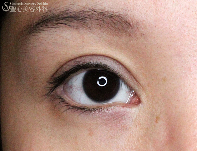 【20代女性・上三白眼】他院眼瞼下垂手術後の修正（3ヶ月後） After 