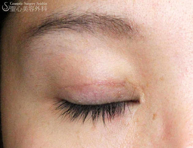 【20代女性・上三白眼】他院眼瞼下垂手術後の修正（3ヶ月後） After 