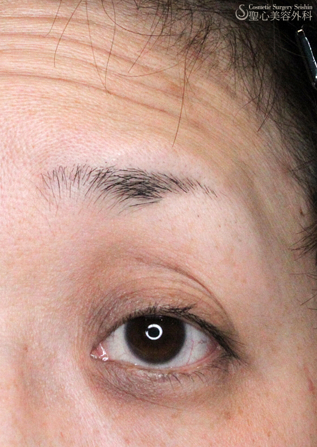 【40代女性・眼瞼下垂＋くぼみ目】埋没法（1ヶ月後） Before 