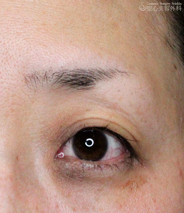 【40代女性・眼瞼下垂＋くぼみ目】埋没法（1ヶ月後） After 