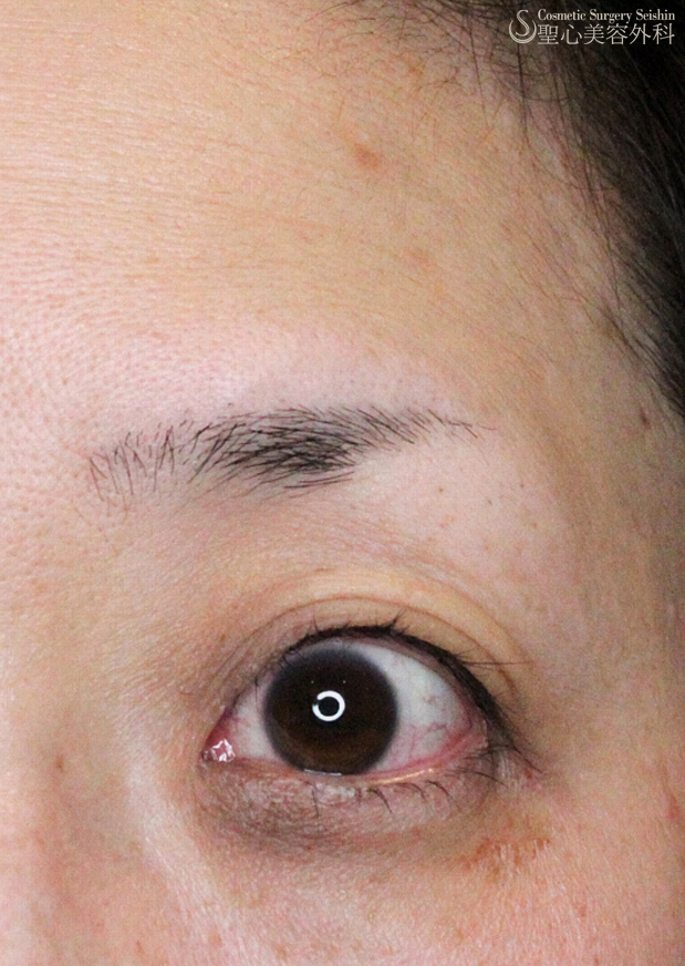 【40代女性・眼瞼下垂＋くぼみ目】埋没法（1ヶ月後） After 