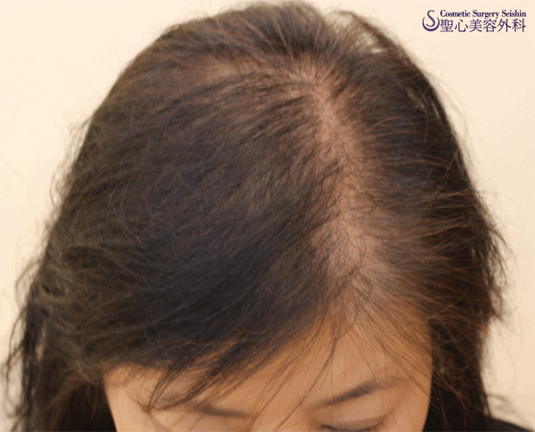 【50代女性・薄毛】グロースファクター再生療法・女性用飲む育毛剤・KIPスカルプエッセンス After 