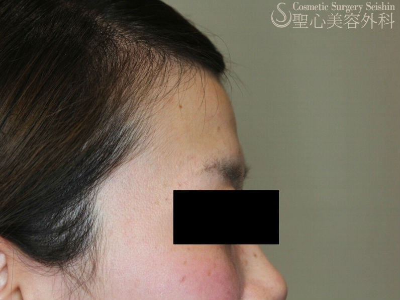 代女性 プレミアムprp皮膚再生療法 おでこを丸くなだらかに 症例写真 美容整形 美容外科なら聖心美容クリニック 代女性 プレミアムprp皮膚再生療法 おでこを丸くなだらかに 症例写真 美容整形 美容外科なら聖心美容クリニック