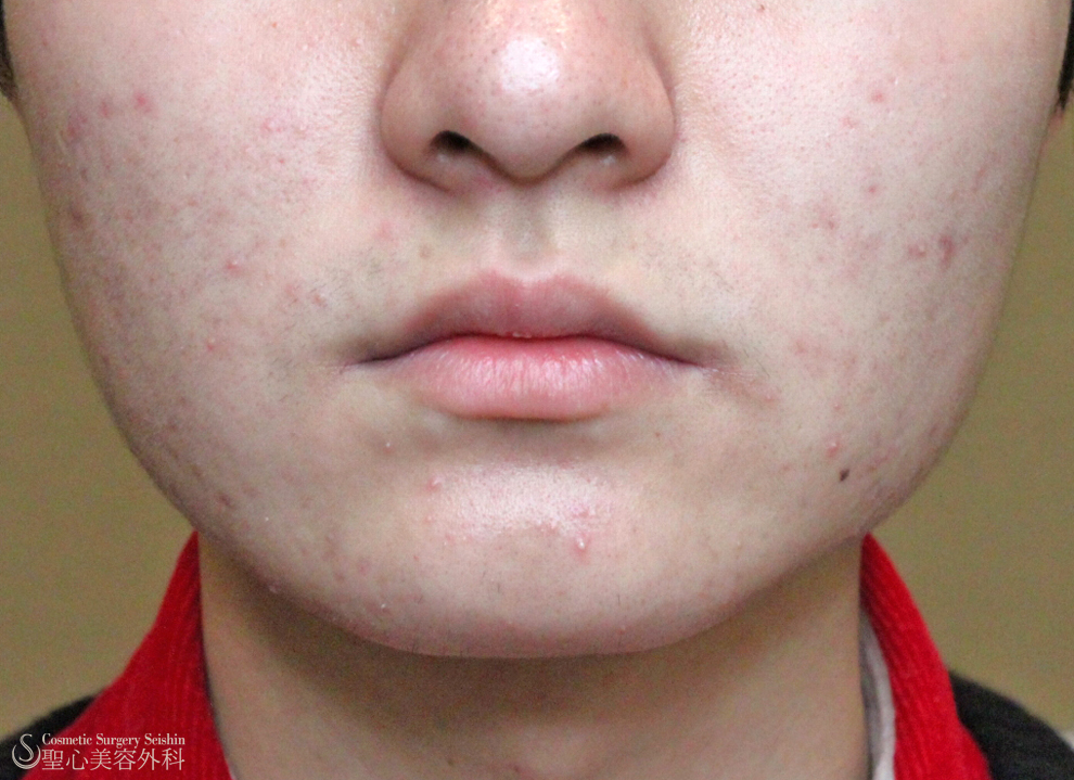 【10代男性・エラ張り】小顔ボトックス治療（6ヶ月後） After 