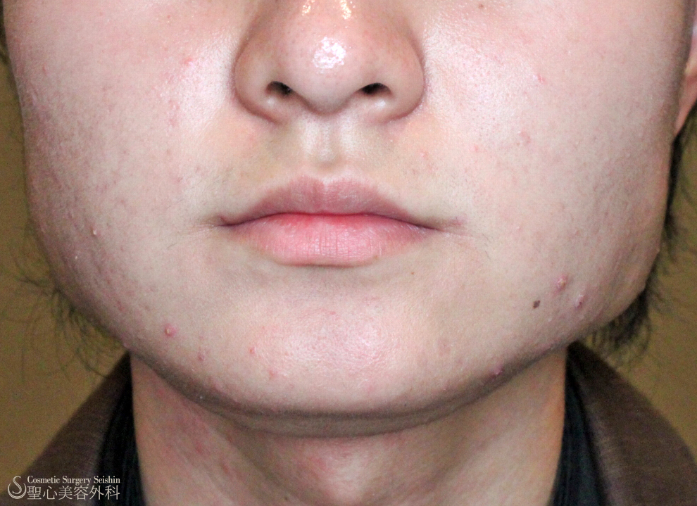 【10代男性・エラ張り】小顔ボトックス治療（6ヶ月後） Before 