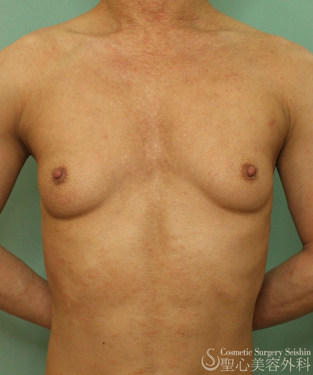 30代男性・真性女性化乳房】乳腺切除術（1ヶ月後） - 症例写真 - 美容整形、美容外科なら聖心美容クリニック